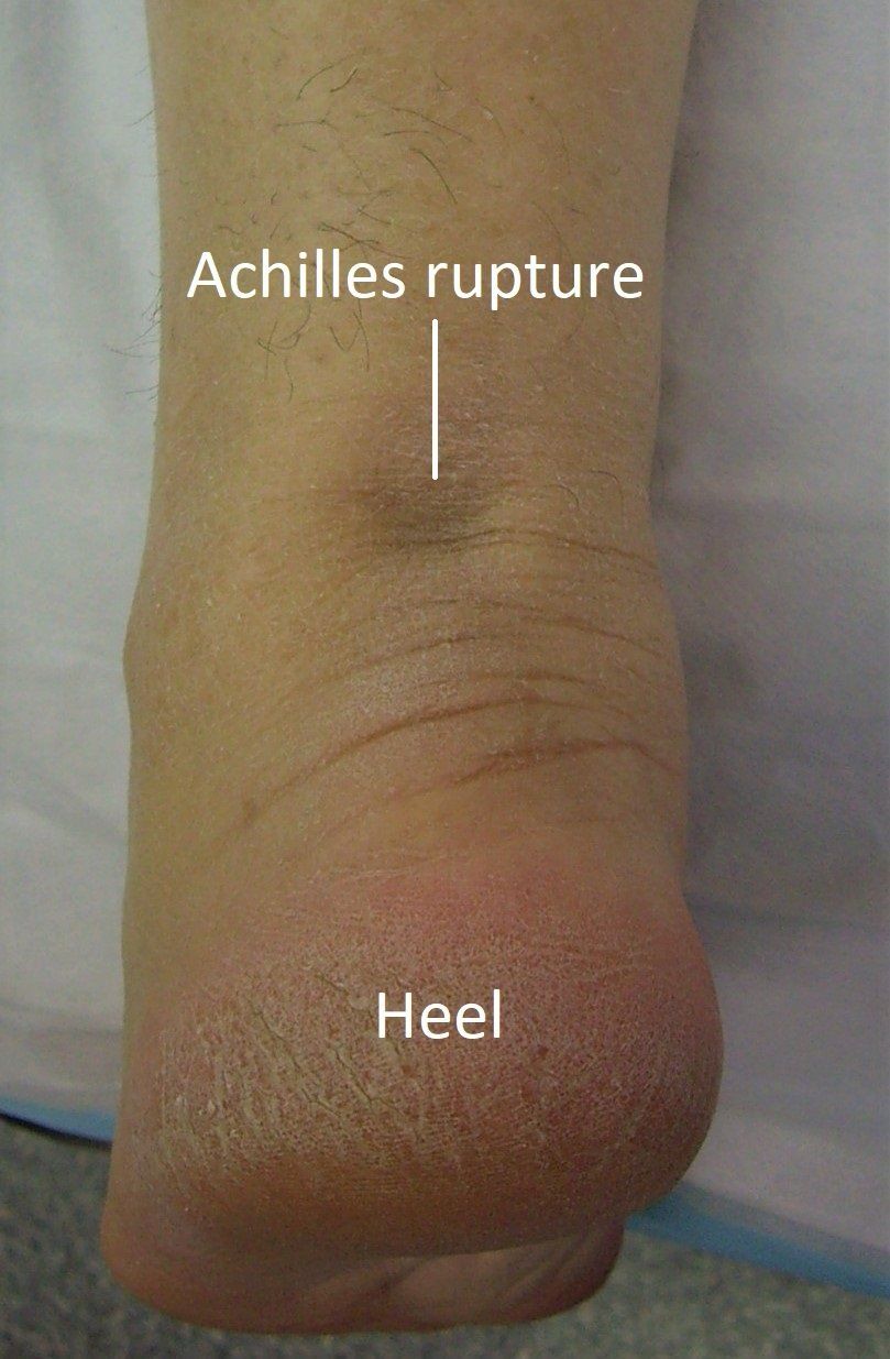 Achilles Tendon Rupture Dr Ben Beamond Adelaide